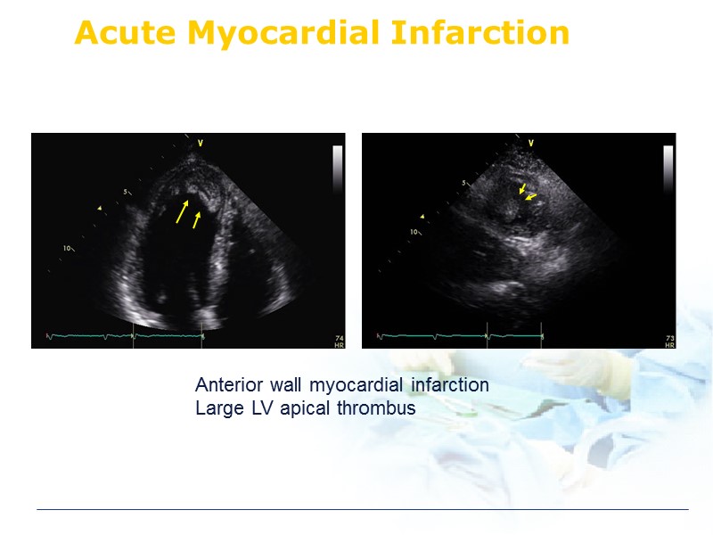 Acute Myocardial Infarction Anterior wall myocardial infarction Large LV apical thrombus